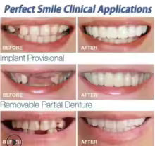 Premium Snap-On Smile – Natural Looking Teeth Instantly